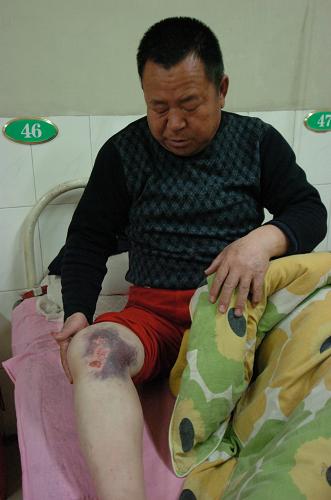 2月7日,一位受傷的農民在靖邊縣人民醫(yī)院接受治療。 新華社記者 馮國 攝